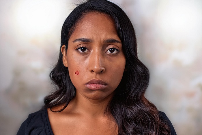 Herpes in India: The Mood Swings No One Talks About